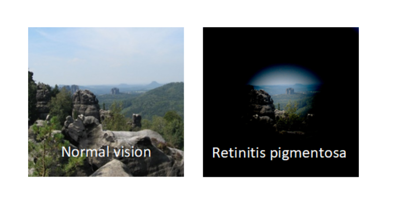 Retinitis Pigmentosa example showing clear view and same view with tunnel vision
