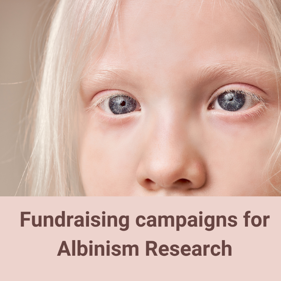 Albinism in children 