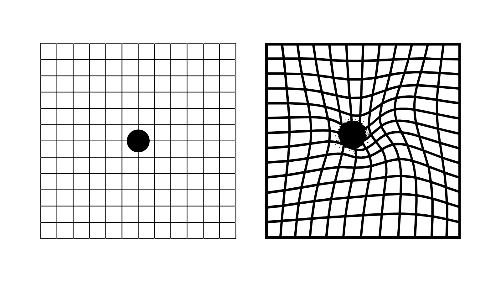 Amsler grid Amsler grid - normal and distorted