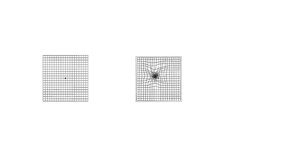 AMD - grid test for vision